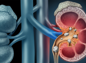 Cảnh báo 8 triệu chứng sớm của sỏi thận tuyệt đối đừng nên chủ quan